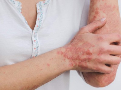 THE EFFECTS OF PSORIASIS ON MENTAL HEALTH