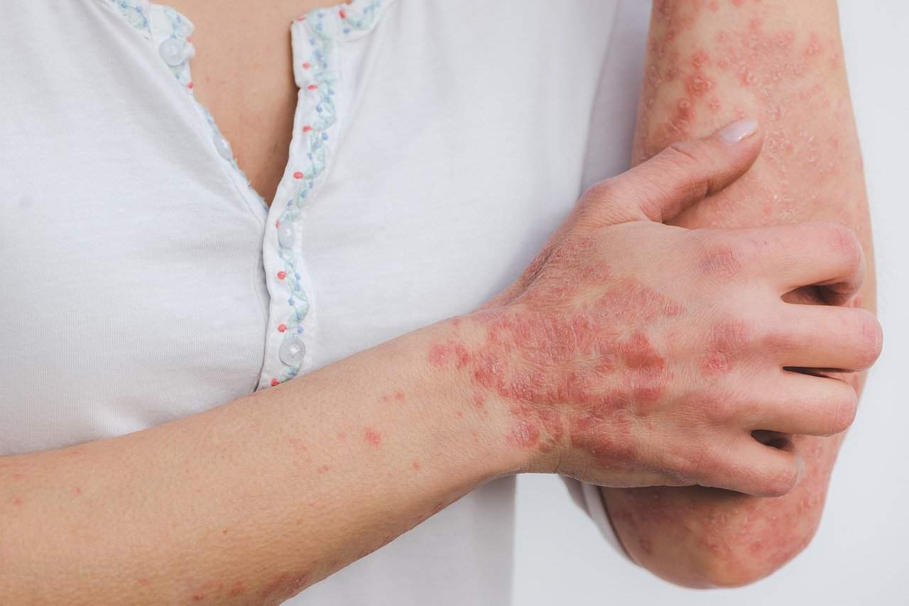 THE EFFECTS OF PSORIASIS ON MENTAL HEALTH